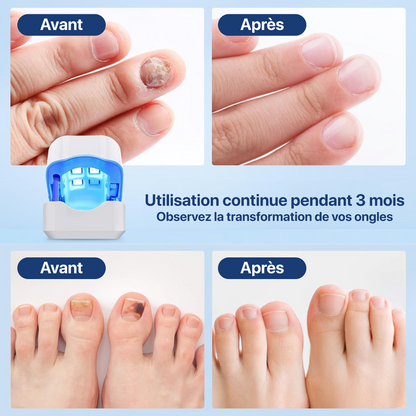 Appareil Traitement Laser Mycose Ongles